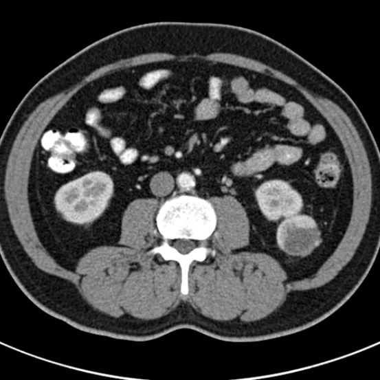 File:Bosniak cyst - type IV (Radiopaedia 23525-23627 renal cortical phase 40).jpg