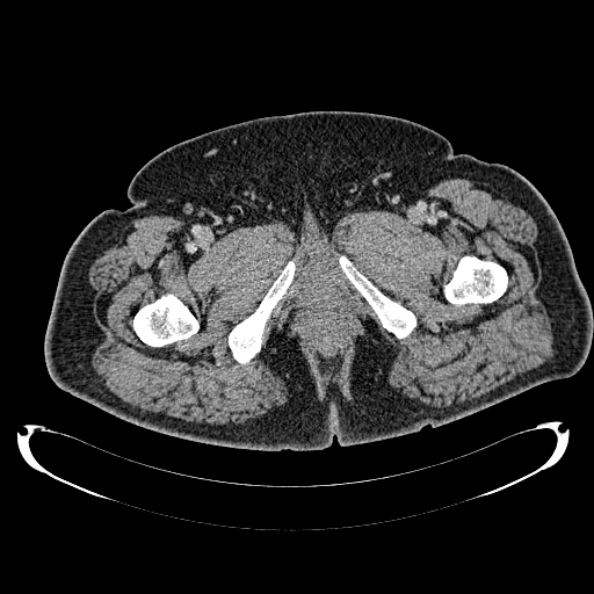 Bosniak renal cyst - type IV (Radiopaedia 24244-24518 C 339).jpg