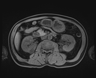 Bouveret syndrome (Radiopaedia 61017-68856 Axial T1 fat sat 45).jpg