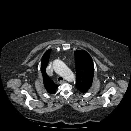Bovine aortic arch - right internal mammary vein drains into the superior vena cava (Radiopaedia 63296-71875 A 33).jpg