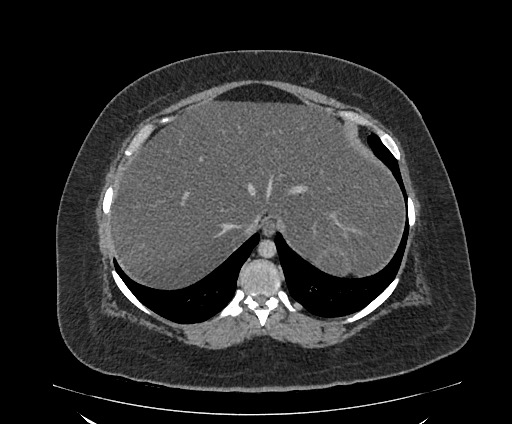 Bowel and splenic infarcts in acute lymphocytic leukemia (Radiopaedia 61055-68913 A 26).jpg