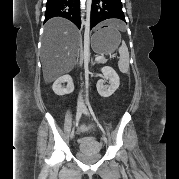 Bowel and splenic infarcts in acute lymphocytic leukemia (Radiopaedia 61055-68915 B 37).jpg