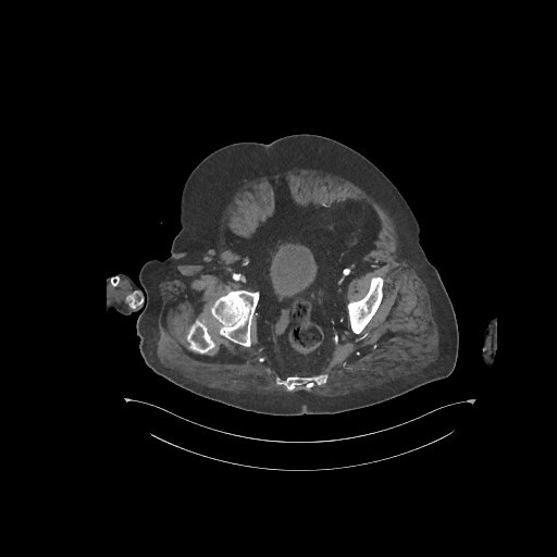 File:Bowel ischemia secondary to SMA occlusion with extensive portomesenteric venous gas (Radiopaedia 54656-60871 A 1).jpg