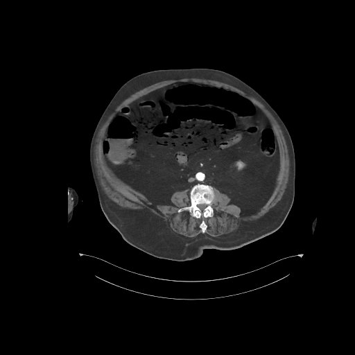 File:Bowel ischemia secondary to SMA occlusion with extensive portomesenteric venous gas (Radiopaedia 54656-60871 A 30).jpg