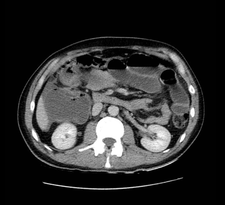 Bowel obstruction from colon carcinoma (Radiopaedia 22995-23028 A 34).jpg