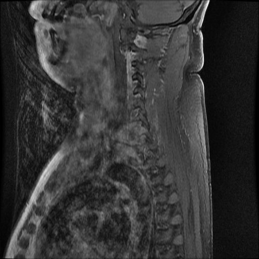 File:Brachial plexus neurofibroma (Radiopaedia 28030-28291 T1 C+ fat sat 8).png