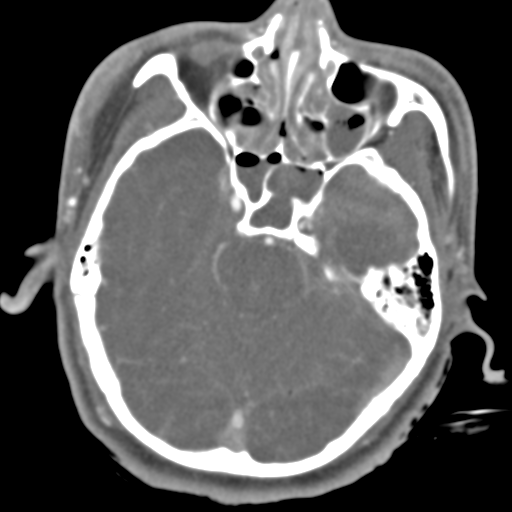 Brain contusions, internal carotid artery dissection and base of skull fracture (Radiopaedia 34089-35339 D 38).png