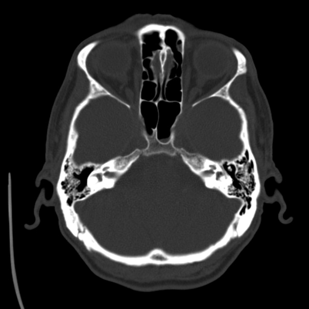 Brain metastases from lung cancer (Radiopaedia 24480-24781 Axial bone window 10).jpg