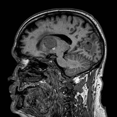 Brain metastases from lung cancer (Radiopaedia 83839-99028 Sagittal T1 52).jpg