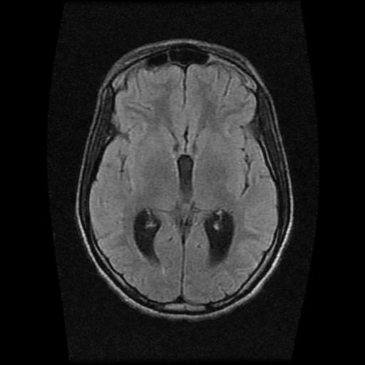 File:Brainstem glioma (Radiopaedia 30923-31624 Axial FLAIR 12).jpg