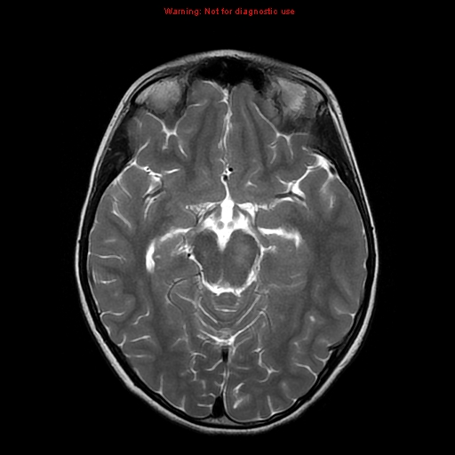 File:Brainstem glioma (Radiopaedia 9444-10124 Axial T2 9).jpg