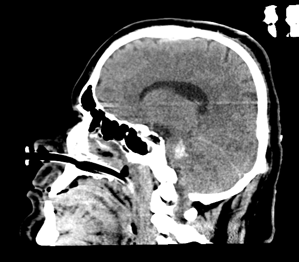 Brainstem hemorrhage (Radiopaedia 81294-94976 C 24).jpg