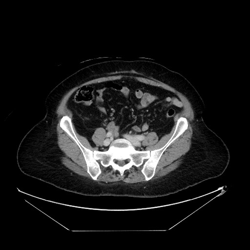File:Breast cancer pseudocirrhosis with lobar invovlement (Radiopaedia 81080-94670 A 113).jpg
