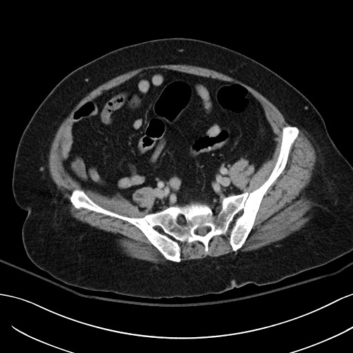 Breast carcinoma with pathological hip fracture (Radiopaedia 60314-67974 B 52).jpg