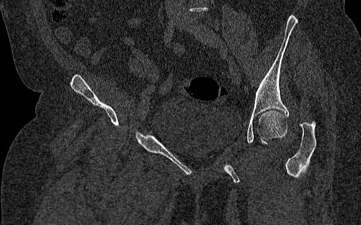 Breast carcinoma with pathological hip fracture (Radiopaedia 60314-67993 Coronal bone window 65).jpg