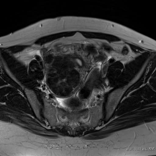 File:Broad ligament fibroid (Radiopaedia 49135-54241 Axial T2 14).jpg