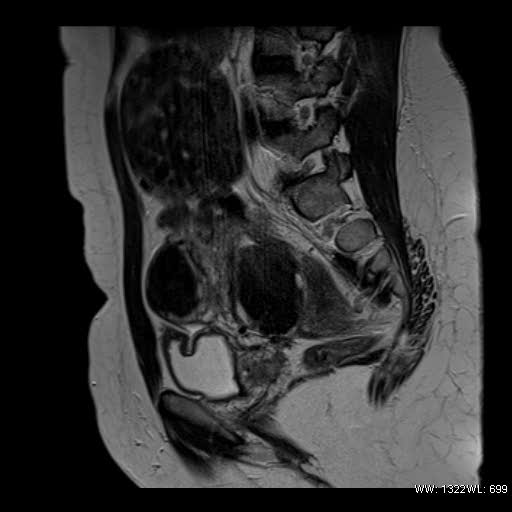 File:Broad ligament fibroid (Radiopaedia 49135-54241 Sagittal T2 17).jpg