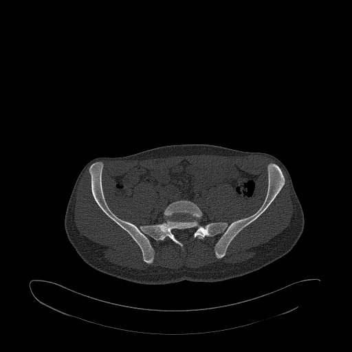 Brodie abscess- femoral neck (Radiopaedia 53862-59966 Axial bone window 27).jpg