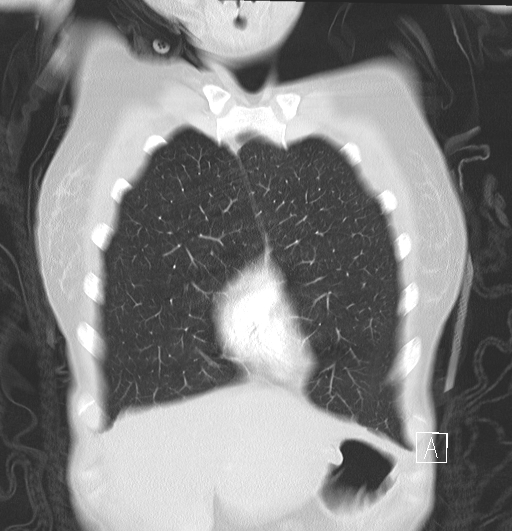 File:Bronchial atresia (Radiopaedia 73677-84470 Coronal lung window 6).jpg