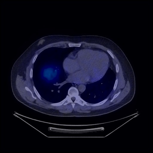 Bronchial carcinoid tumor (Radiopaedia 67377-76765 68Ga-DOTATATE PET-CT 35).jpg