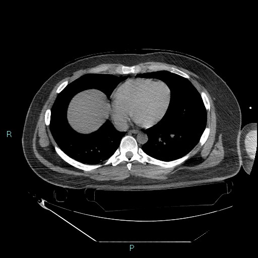 Bronchial carcinoid tumor (Radiopaedia 78272-90870 Axial non-contrast 71).jpg