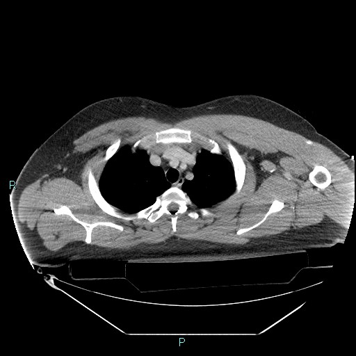 Bronchial carcinoid tumor (Radiopaedia 78272-90870 C 30).jpg