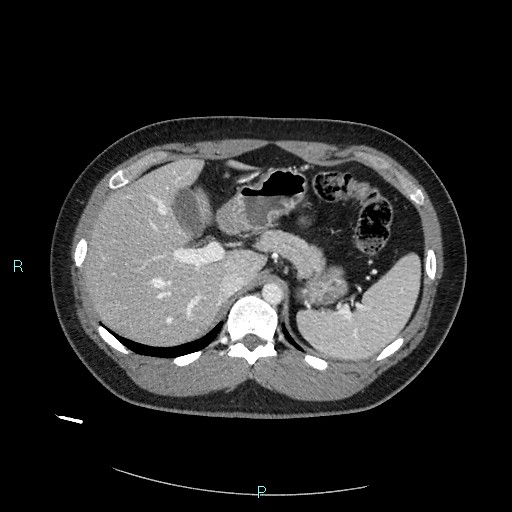 Bronchial carcinoid tumor (Radiopaedia 78272-90875 A 95).jpg