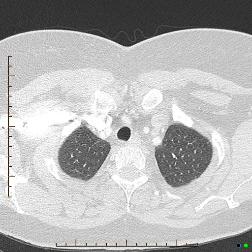 Bronchial diverticula (Radiopaedia 79512-92676 Axial lung window 14).jpg