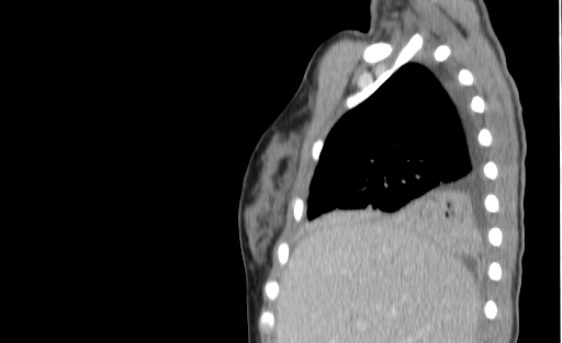 Bronchial mucoepidermoid carcinoma (Radiopaedia 57023-63895 Sagittal 35).jpg