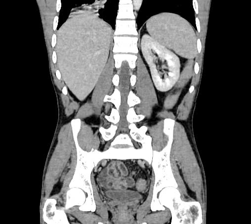Bronchiectasis in Crohn disease (Radiopaedia 60311-67977 C 57).jpg