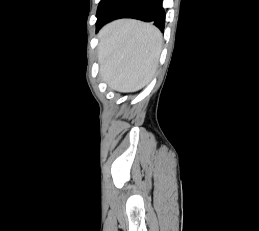 Bronchiectasis in Crohn disease (Radiopaedia 60311-67977 D 5).jpg