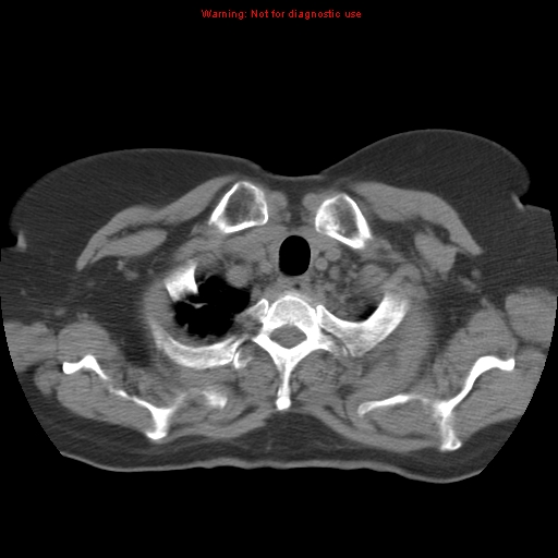 Bronchoalveolar carcinoma (Radiopaedia 13224-13233 Axial non-contrast 6).jpg