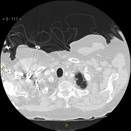 File:Bronchogenic carcinoma as an incidental finding (Radiopaedia 16453-16130 Axial lung window 111).jpg