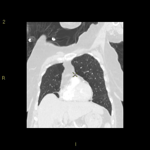 File:Bronchogenic carcinoma as an incidental finding (Radiopaedia 16453-16130 Coronal lung window 18).jpg