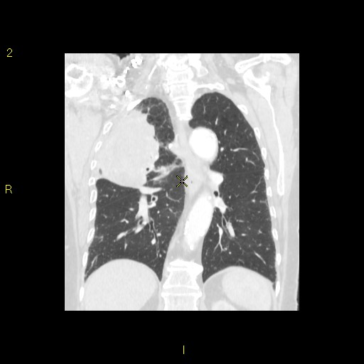 File:Bronchogenic carcinoma as an incidental finding (Radiopaedia 16453-16130 Coronal lung window 33).jpg