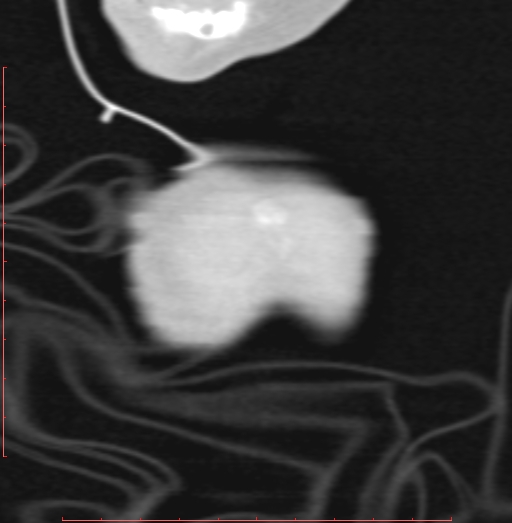 Bronchogenic cyst (Radiopaedia 78599-91409 Coronal lung window 1).jpg