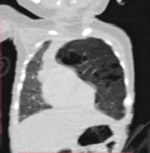 Bronchogenic cyst (Radiopaedia 78599-91409 Coronal lung window 66).jpg