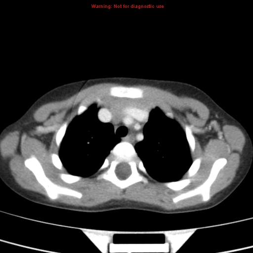 File:Bronchogenic cyst (Radiopaedia 9372-10063 C 2).jpg