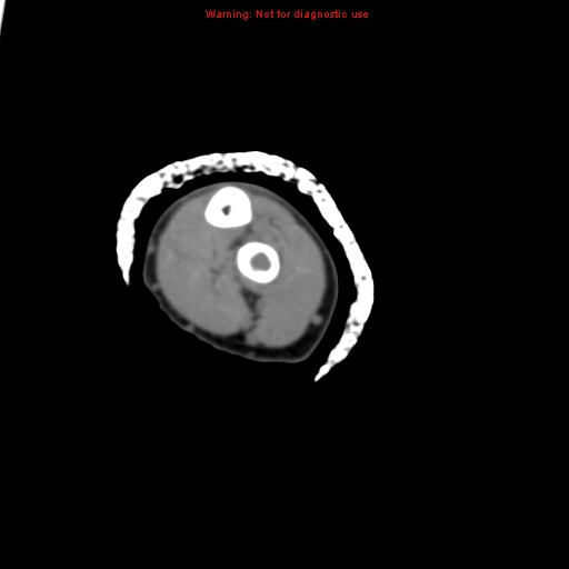 File:Brown tumor (Radiopaedia 12460-12694 Axial non-contrast 109).jpg