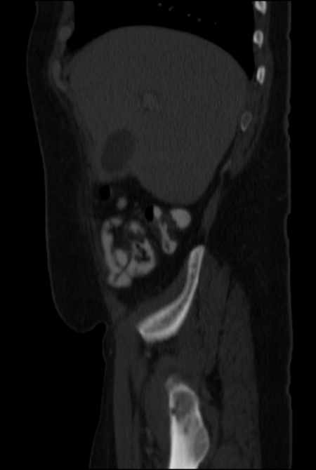 Brown tumors compressing the spinal cord (Radiopaedia 68442-77988 H 13).jpg