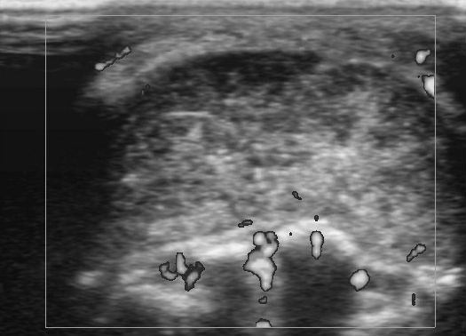 File:Buccal mucosal retention cyst on sonography (Radiopaedia 12196-12521 D 1).jpg