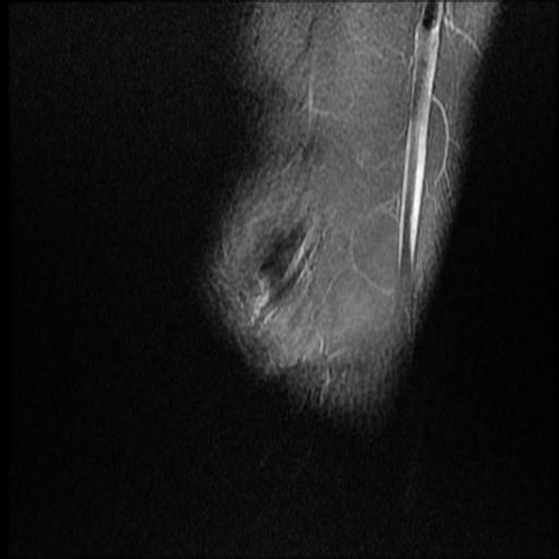 File:Bucket handle tear - medial meniscus (Radiopaedia 69245-79026 Sagittal PD fat sat 18).jpg