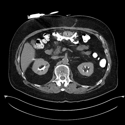 Buried bumper syndrome - gastrostomy tube (Radiopaedia 63843-72577 Axial Inject 35).jpg