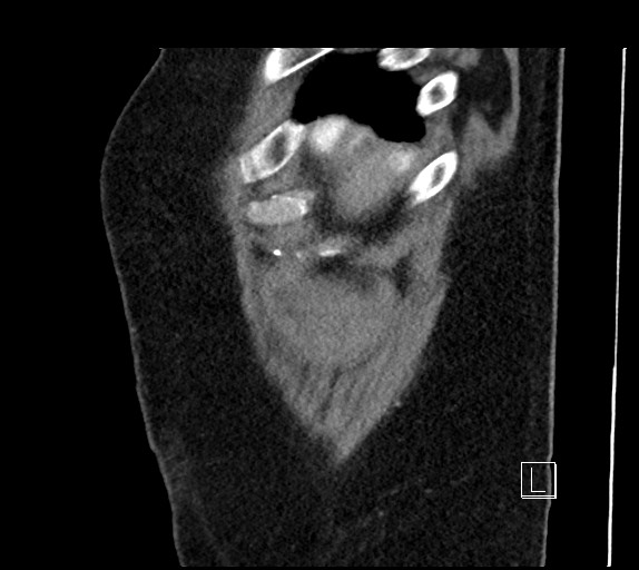 Buried bumper syndrome - gastrostomy tube (Radiopaedia 63843-72577 Sagittal Inject 113).jpg