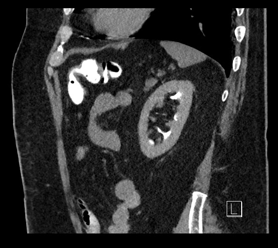 Buried bumper syndrome - gastrostomy tube (Radiopaedia 63843-72577 Sagittal Inject 31).jpg