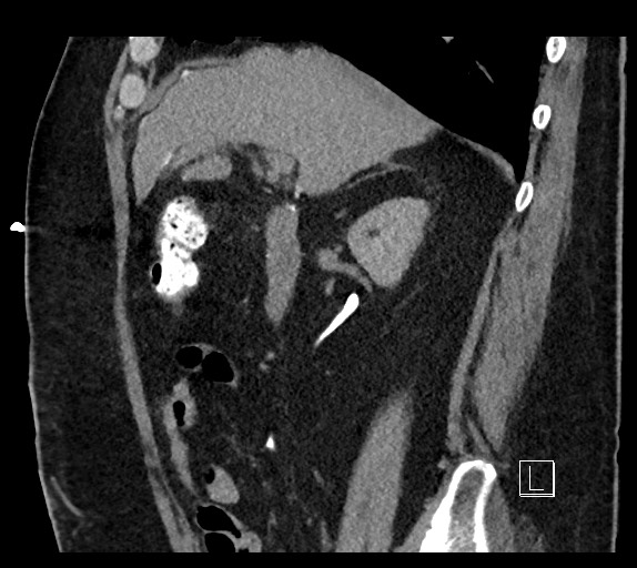 Buried bumper syndrome - gastrostomy tube (Radiopaedia 63843-72577 Sagittal Inject 80).jpg