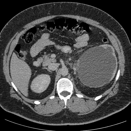 Burned-out testicular seminoma - retroperitoneal nodal metastases (Radiopaedia 62872-71245 A 26).jpg