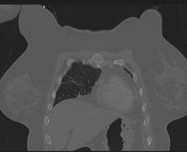Burst fracture - thoracic spine (Radiopaedia 30238-30865 Coronal bone window 35).jpg