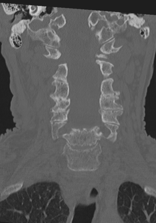 C2 fracture with vertebral artery dissection (Radiopaedia 37378-39199 Coronal bone window 20).png