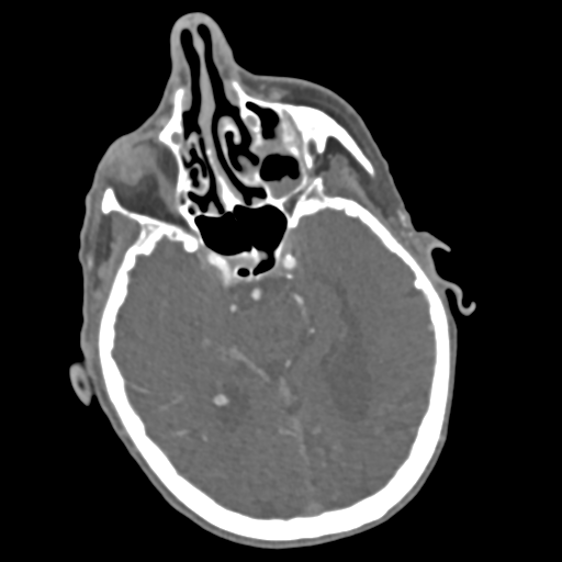 File:C2 fracture with vertebral artery dissection (Radiopaedia 37378-39200 A 231).png
